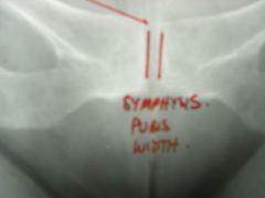 Symphysis Pubis Width