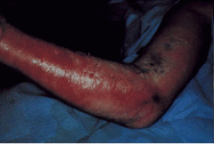 Necrotizing fasciitis. Patient is in late stage as there is crepitus and anesthesia (pain subsiding). Usually caused by group A strep. If this was biopsied there would be gram positive cocci in chains. Management is surgical debridement without de...