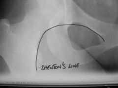 Shenton's Line