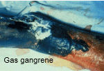 Gas gangrene caused by Clostridum perfringens. Post-traumatic, devitalized tissue permits anaerobic growth. Alpha toxins are produce which leads to tissue injury and gas development. Management is debridement, leaving the wounds open, and antibiot...
