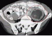 Patient presents with pain upon hyperextending his hip. Patient's CT scan is shown on the left. What can cause this finding and what is the management?