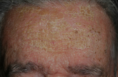 - dandruff

-  scaly, flaky, itchy, and red skin
- particularly affects the sebaceous-gland-rich areas of skin
- yellow/waxy