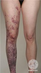VG5Q, RASA1, GNAQ
 
sporadic, vascular malformation of a limb associated with bone and soft tissue hypertrophy of the affected extremity with lymphatic and deep venous insufficiency