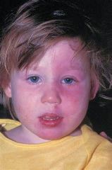 GNAQ
 
Sturge–Weber syndrome
 
Sturge–Weber syndrome, sometimes referred to as encephalotrigeminal angiomatosis, is a rare congenital neurological and skin disorder. It is one of the phakomatoses and is often associated with port-wine stains o...