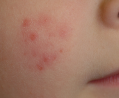 how DDx tinea from lupus or psoriasis