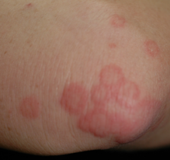 is this tinea?

- no scale but annular