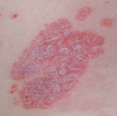 Red plaques
thick silvery scale
inflammatory disease