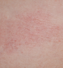 why would you think you are dealing with Cutaneous T-cell lymphoma (CTCL)?

How Dx to confirm your suspicion?