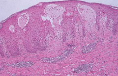 Gestational pemphigoid

AKA herpes gestationis