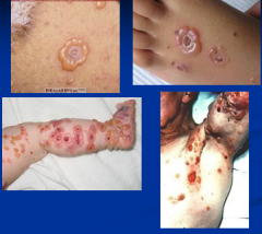 Dx?

Children
- Annular erythema
- blisters
- where - flexural areas / lower trunk / thighs / groin
- "crown of jewels" - the annular blisters

Adult
- looks like BP (bullous pemphigoid)

BP180 (BPAg2) = roof
DIF - Linear deposition of...