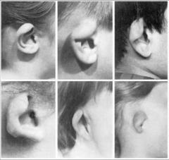 ear is constricted or folding on itself 


Different degrees