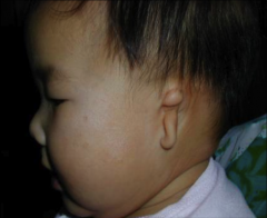 external ear is severely underdeveloped and malformed - mound of tissue


also missing the EAC - can't hear on one side


Grade 1-3 to convey how sever the microtia is


Can have microtia reconstructive surgery 