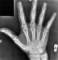 Sesamoid Bones of the Hand