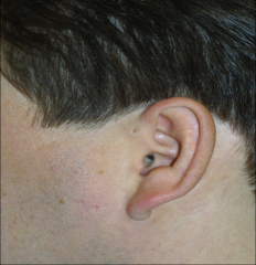 Dimple in the skin in front of the ear, superior to EAM opening - most of the time it is a skin lined tunnel that is 1-2cm long