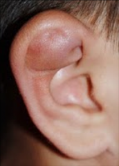 Most commonly due to trauma


Collection of blood between cartilage and pericardium 


Can have CHL: EAC swelling, hemotympanum (middle ear blood), ossicular injury/discontinuity 


In children - rule out abuse


Urgent referral indicate...