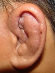 Occurs secondary to hematoma


auricular traum - hematoma - cauliflower ear (if hematoma left untreated)


hematoma disrupts blood supply to auricular cartilage which leads to cartilage necrosis (death) and neocartilage formation 


 


...