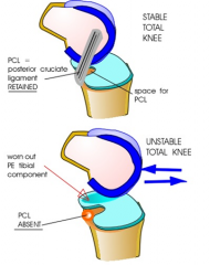 Posterior cruciate retaining knees require a functional PCL to produce femoral rollback during knee flexion. Posterior-stabilized knees rely in the component to produce femoral rollback. Contraindications to using a posterior cruciate retaining kn...