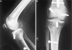 A 55-year-old patient is scheduled for total knee arthroplasty. A radiograph is provided in Figure A. Each of the following are risk factors for heterotopic ossification EXCEPT? 1-Valgus knee deformity; 2-Male gender; 3-Obesity; 4-Hx of trauma; 5-...