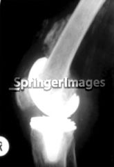 Heterotopic bone ossification (HO) following TKA has not been associated with valgus knee deformity. HO formation can be problematic both after a THA and TKA, but unlike the hip, it rarely becomes a clinical problem. The overall incidence of HO af...
