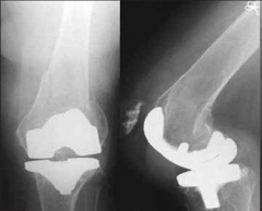 All of the following are risk factors for post-operative total knee arthroplasty periprosthetic supracondylar femur fractures EXCEPT?  1-RA; 2- Parkinson's dz; 3-Chronic steroid therapy; 4-Revision knee arthroplasty; 5-Male gender