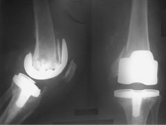 Rheumatoid arthritis, Parkinson's disease, chronic steroid therapy, osteopenia, and female gender have all been found to be risk factors for post-operative periprosthetic supracondylar femur fractures. Male gender has not been found to be a risk f...