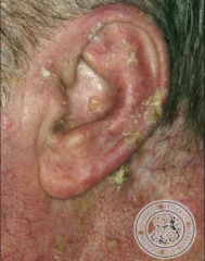 Pre-malignant lesion caused by sun exposure


thick, crusty patches of skin


can progress to SCC


early removal recommended (surgery, laser, liquid nitrogen)


can lead to squamous cell carcinoma 
