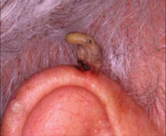 Conical projection above skin surface


composed of compacted keratin


base may be malignant - requires surgical excision 