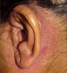 Bacterial skin infection caused by staph aureus


usually associated with hearing aid molds and poor hygiene 