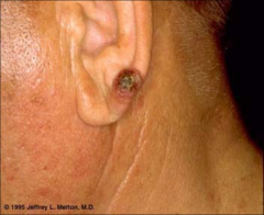 More aggressive than BCC


higher incidence of metastasis 


often a progression from sun-damaged areas (e.g. actinic keratoses)


erythematous, crusting, ulcerated (tends to bleed) lesion with granular friable base


thick, hyperkeratoti...