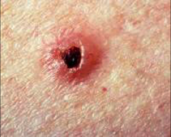 Most common human malignant disease


20% of all cancers in men


10-15% of all cancers in women


85% of all BCC occur in head and neck - due to exposure 


Raised skin lesion


smooth "rolled" pearly translucent border 


telangiec...