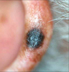 Most aggressive type of skin cancer


responsible for 75% of deaths caused by skin cancers


increasing incidence - especially in young people


derived from melanocytes 


dark pigmented lesion


treatment - surgery, chemotherapy, immu...