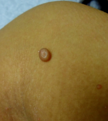 small skin colored papules with indented centers  accompanied by pruritus & surrounding dermatitis

caused by poxvirus

children most commonly affected but also immunocompromised (adult pt with it --> think HIV)

usually self-limited

transmissi...