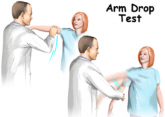 Drop arm rotator cuff test:
- Indicates a large rotator cuff tear