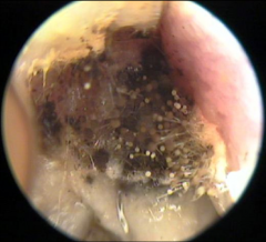Fungal infection of the EAC


Fungal elements visible


Aspergillus fumigatus, Aspergillus niger, Candida albicans are most common forms


Features


wet feeling in the ear


Pruritis (itching) deep within the ear


Dull pain or discom...