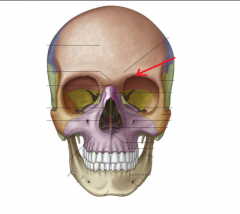 Name this bony marking. Along with tissue, this creates the foramen through which the supraorbital n. passes. 