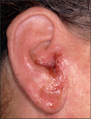 Acute infection of the EAC by Pseudomonas auriginosa 


Causes


spontaneous /idiopathic (don't know cause)


local trauma


frequent swimming


chronic OE - acute flare ups on top of acute 


Symptoms


Otalgia with ear movement

...