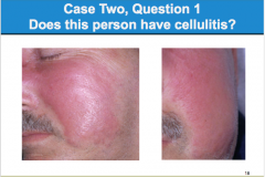 Does this person have cellulitis? If so, what is the type?