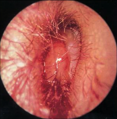 Aka malignant external otitis


Infection of the temporal bone - osteomyelitis (bone infection)


Mostly affects elderly with diabetes - immunosuppressed


Often preceded by EAC trauma or OE


Features


severe otalgia (pain)


otorrhe...