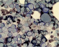 Sudan Black B
Differs AML from ALL
stains lipids found in granules of neutrophils and monos to black 
CONSIDER BLASTS ONLY!

Positive = >5% cells w/ black
Positive = AML