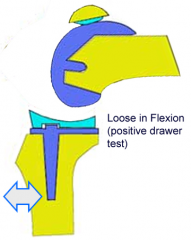 Increasing the size of the femoral component posteriorly will balance a flexion-extension mismatch where the knee is loose in flexion and stable/balanced in extension. The referenced article by Peters discusses multiple different soft tissue balan...
