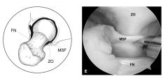 ) The zona orbicularis is the arthroscopic landmark for access to which of the following structures? 
-clinical significance re tx?