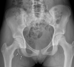 A 15-year-old boy sustains the injury seen in Figure A while running the hurdles. The same mechanism in an adult athlete would most likely result in which of the following injuries? 
-indications for surgery?