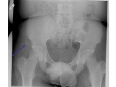 avulsion of anterior inferior iliac spine (AIIS) adolescent athletes may have proximal bony avulsion of anterior inferior iliac spine (AIIS)
injury?
-MoI?
