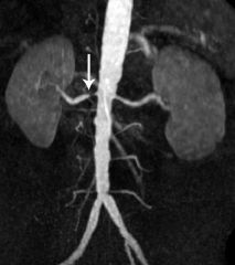 1. Renal arteriogram is the gold standard, but contrast dye can be nephrotoxic-- do NOT use in patients with renal failure
2. MRA has high sensitivity and specificity. The magnetic due is not nephrotoxic so it can be used in patient with renal fa...