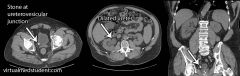 1. the development of stones within the urinary tract
2. a. ureterovesicular junction - most common site of impaction, b. calyx of the kidney, c. ureteropelvic junction, d. intersection of the ureter and the iliac vessels (near the pelvic brim)