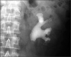 - staghorn stones
- account for 5-10% of stones
- radioDENSE (visible on abd xray), rectangular prisms
- occur in patients with recurrent UTIs with urease-producing organisms (Proteus, klebsiella, serratia, enterobacter spp)
- They are facilit...