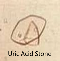 - second most common form - 10% of stones
- a persistently acidic urine pH (<5.5) promotes uric acid stone formation
- these are associated with hyperuricemia, secondary to gout or to chemotherapy treatment of leukemias and lymphomas with high c...