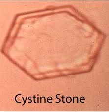 - account for 1% of urinary stones
- genetic predisposition is important (cystinuria- AR)
- hexagon-shaped crystals are poorly visualized