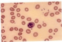 What type of Anemia is depicted in this image?