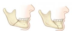 Which mandibular fracture is more favourable? Why?